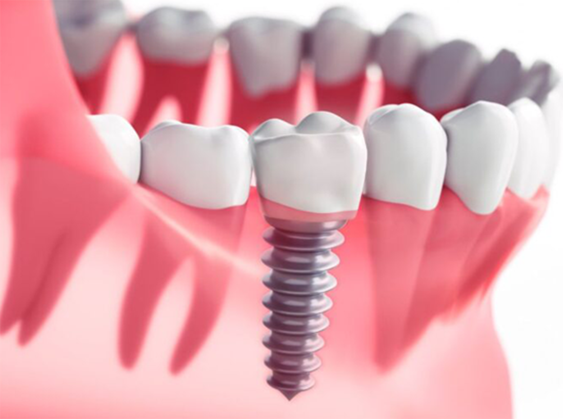 人生主導型インプラント