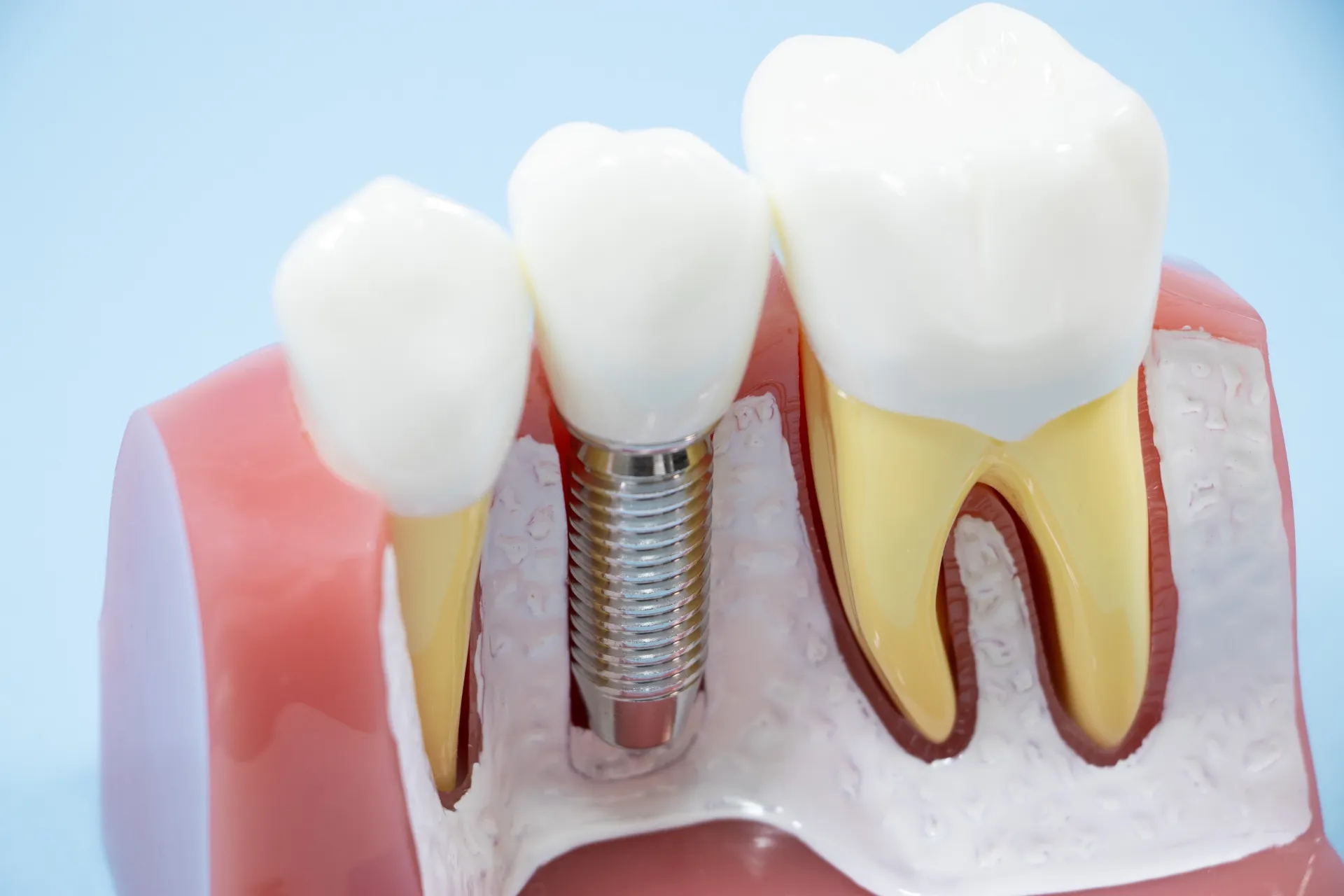 インプラントの流れ