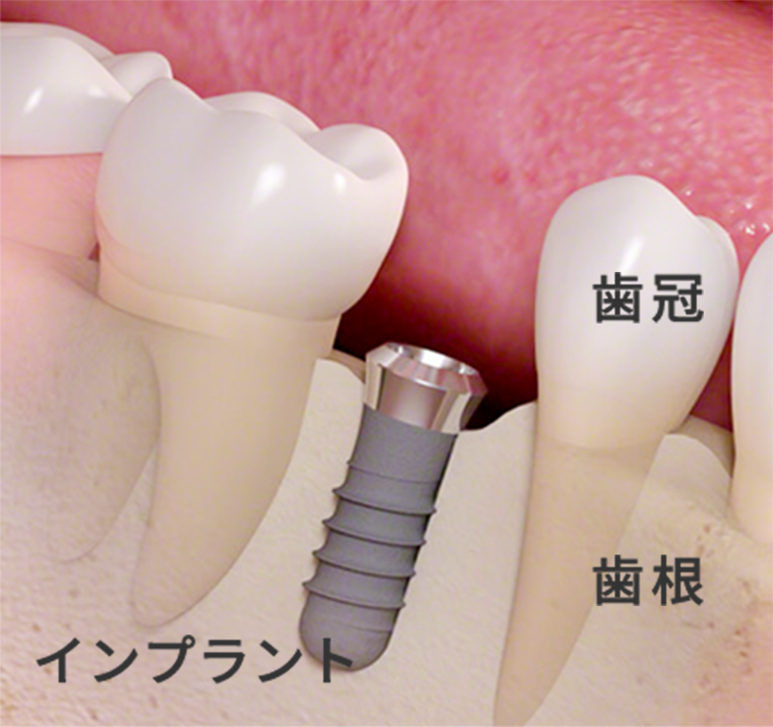 インプラントの流れ