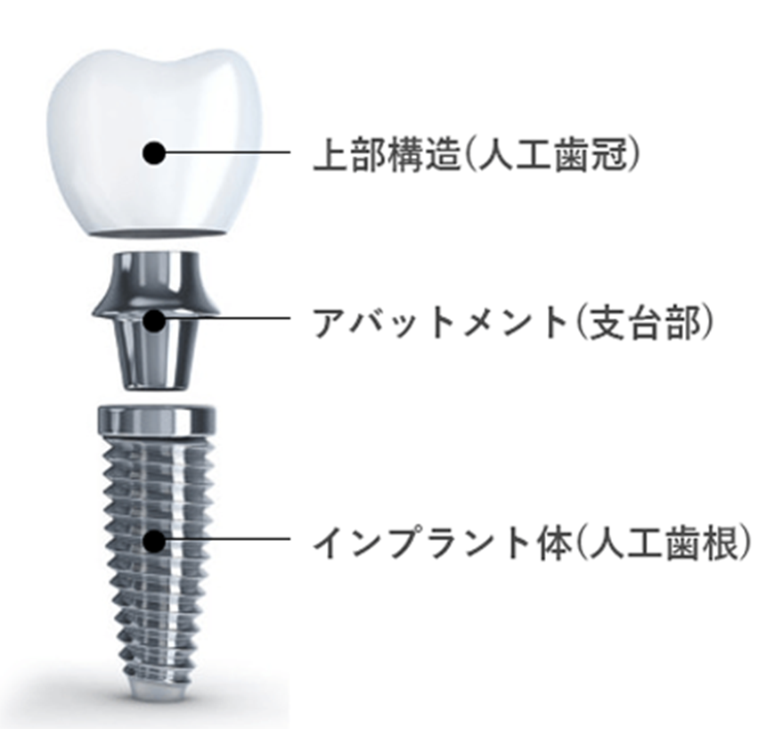 インプラントの流れ