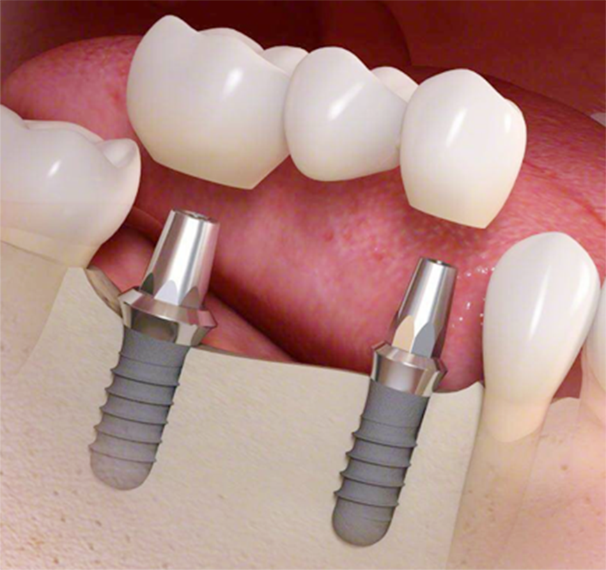 インプラントの流れ