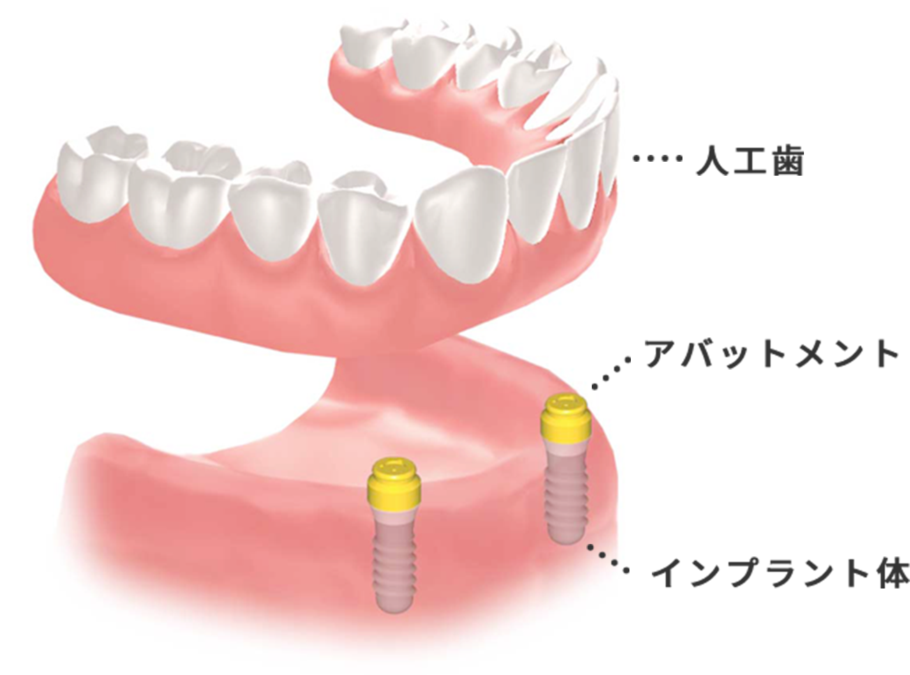 インプラントの利点とは
