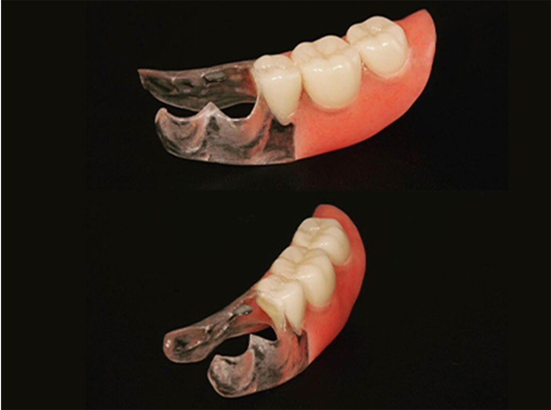 クリアクラスプデンチャー