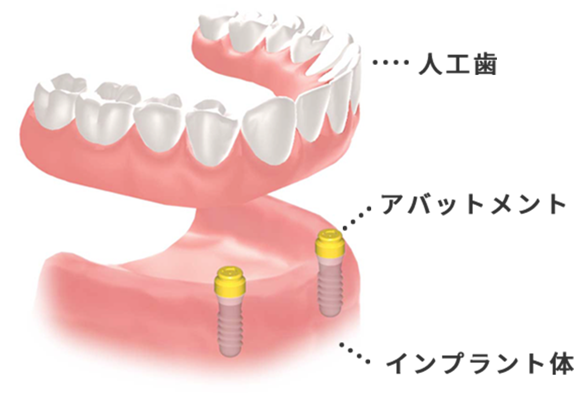インプラントオーバーデンチャー