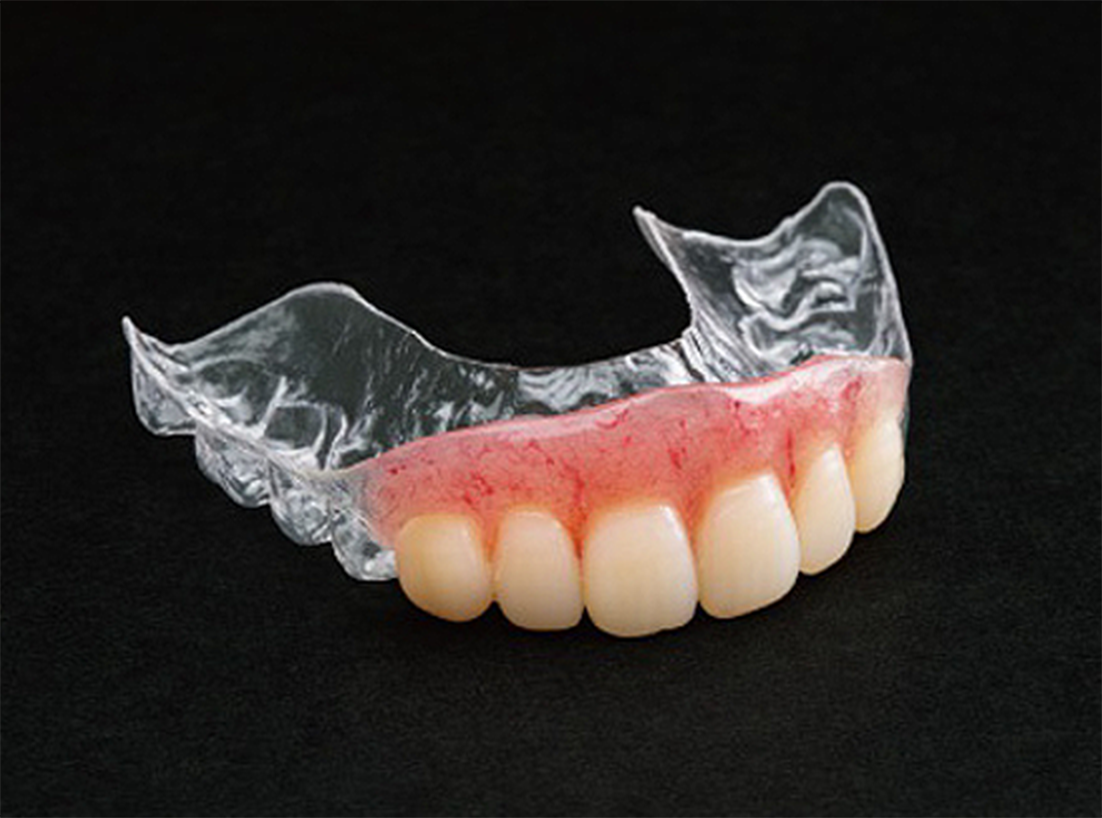 リテーナーデンチャー