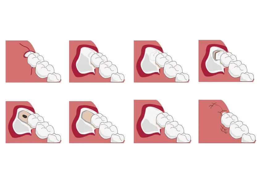 当院のむし歯治療