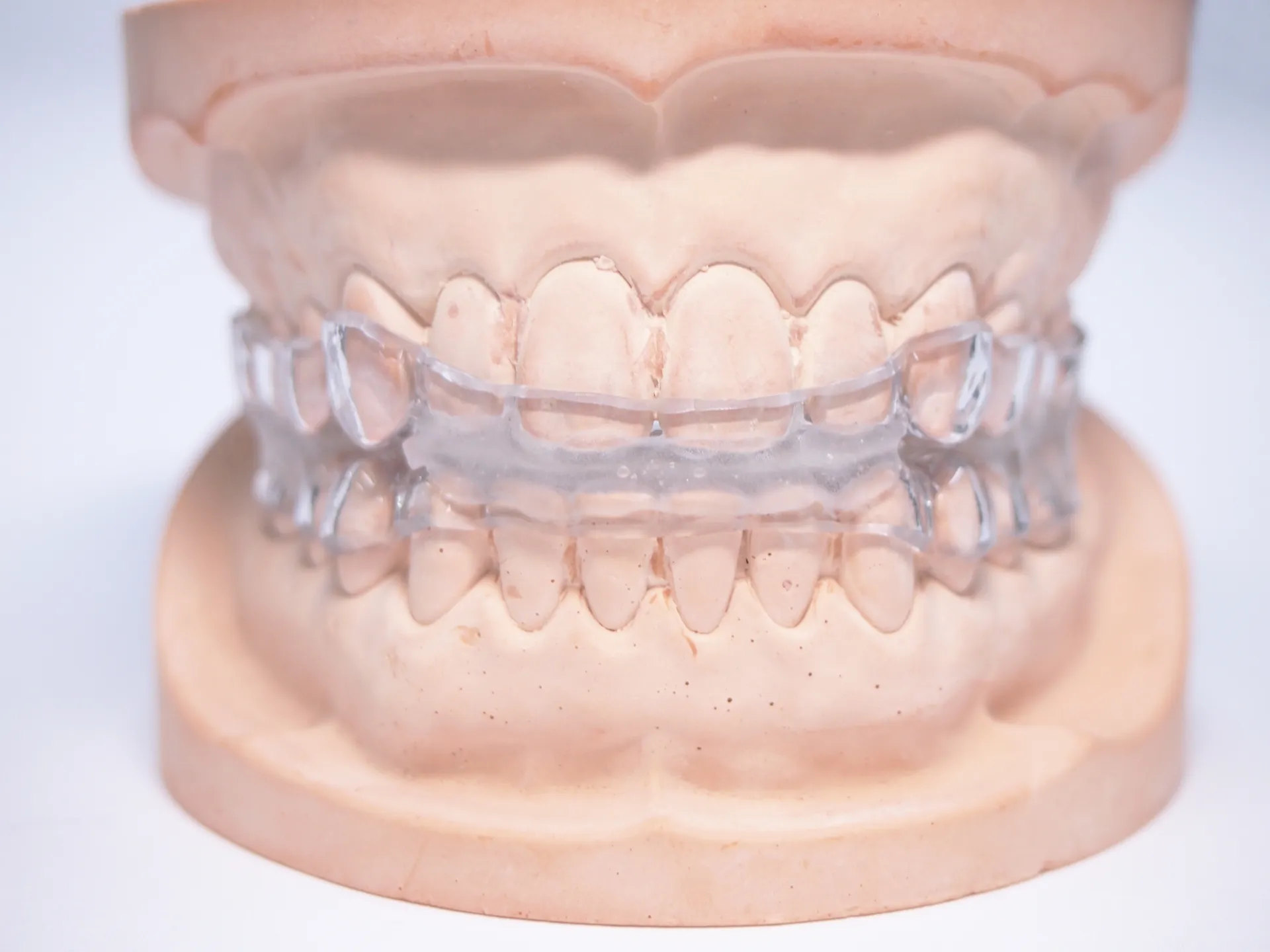 ナイトガード（歯ぎしり・顎関節症対策）