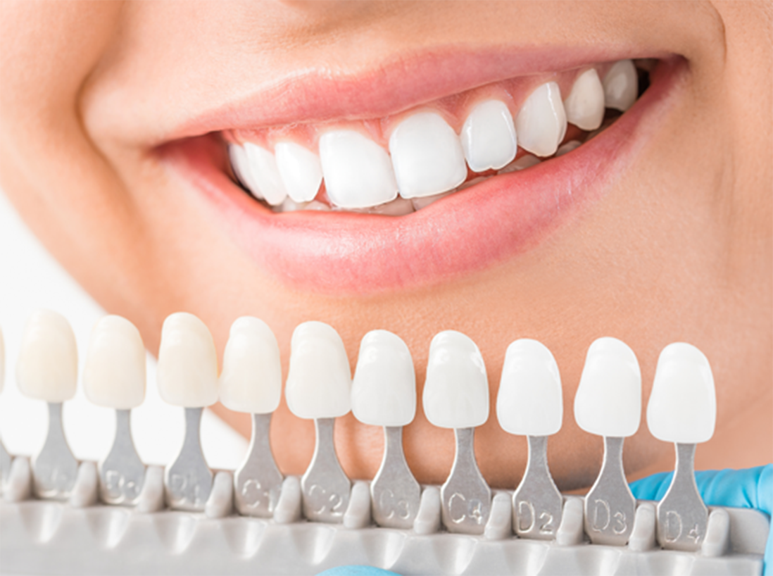 ホワイトニング