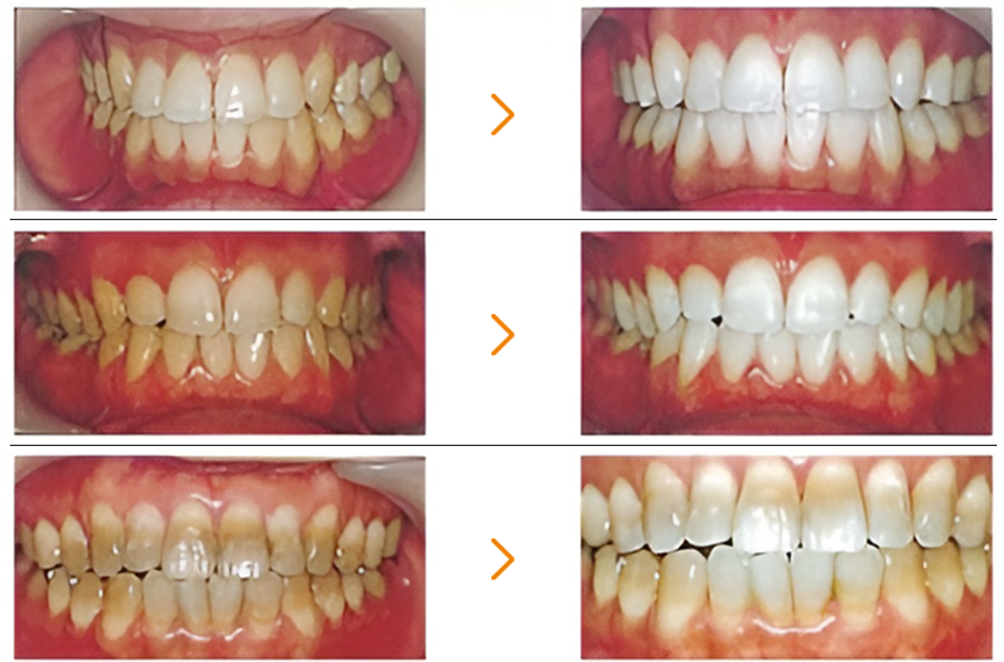 ホワイトニングとは？