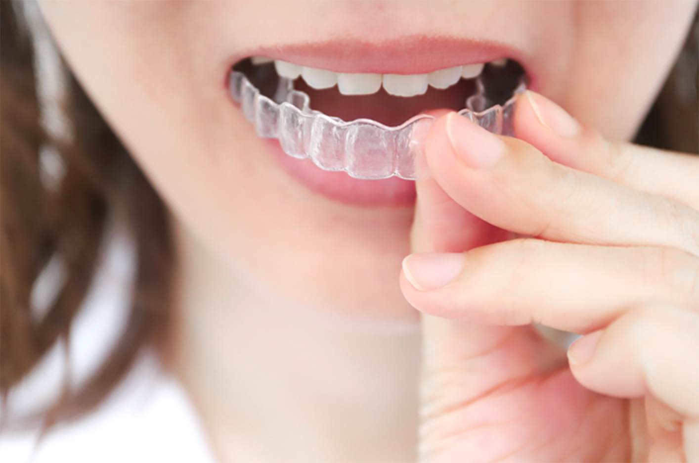 当院オススメのホワイトニング法