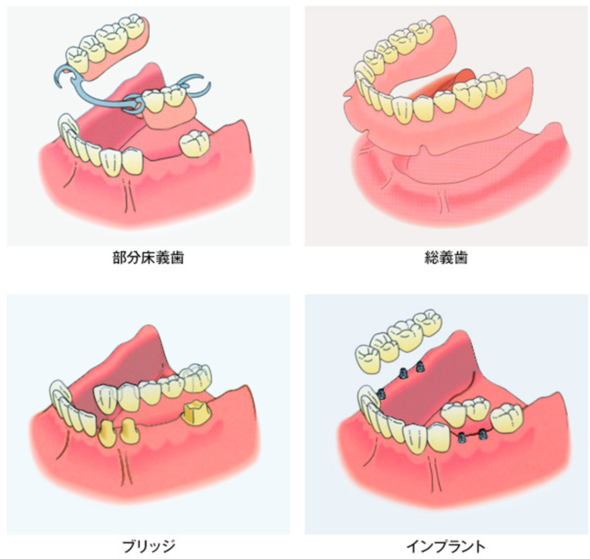 インプラントの利点とは