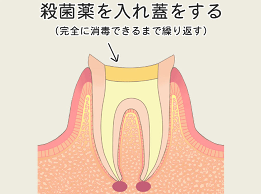殺菌薬